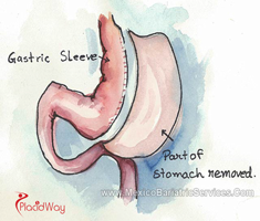 Slider image (3) Dr. Hector Perez Corzo Bariatric Surgery Mexico